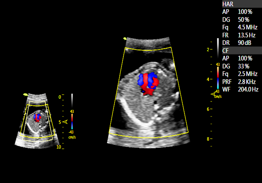 Bloodflow of fetal heart - RF zoom